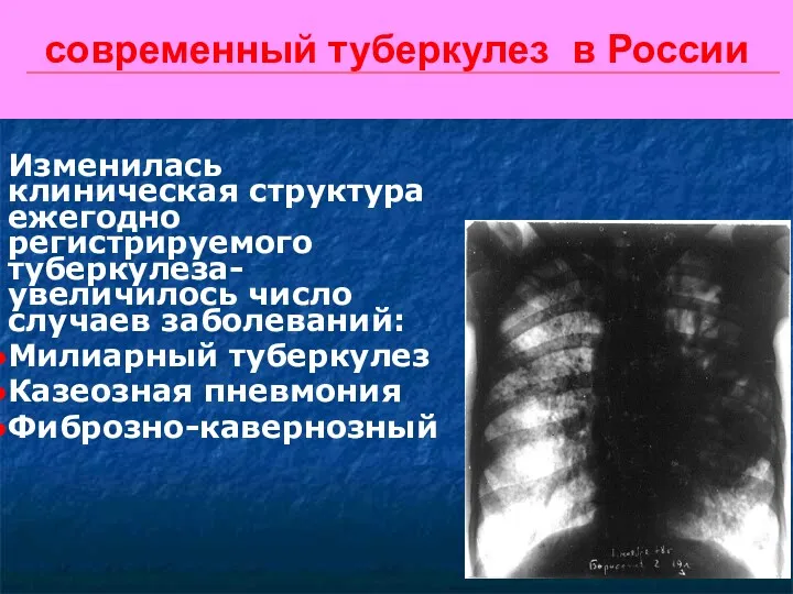 современный туберкулез в России Изменилась клиническая структура ежегодно регистрируемого туберкулеза-