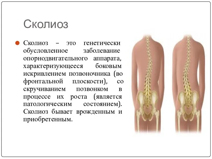 Сколиоз Сколиоз – это генетически обусловленное заболевание опорнодвигательного аппарата, характеризующееся