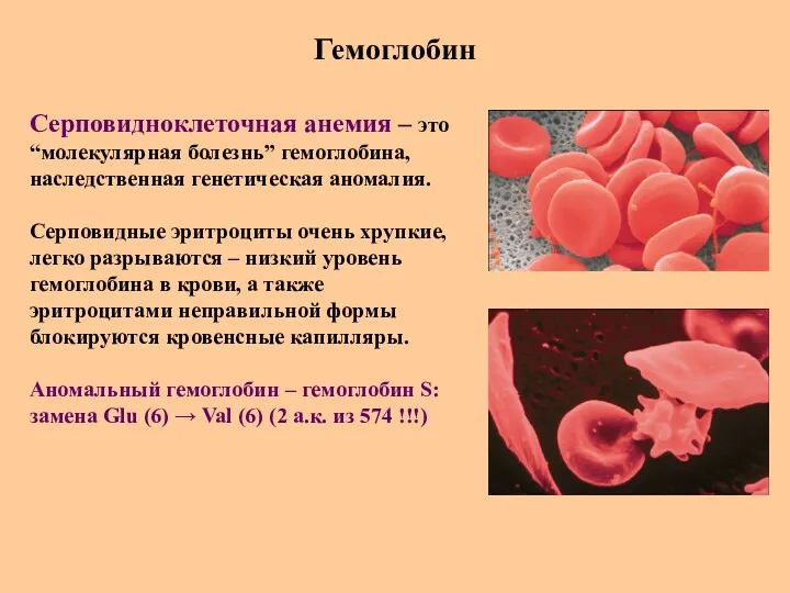 Гемоглобин Серповидноклеточная анемия – это “молекулярная болезнь” гемоглобина, наследственная генетическая