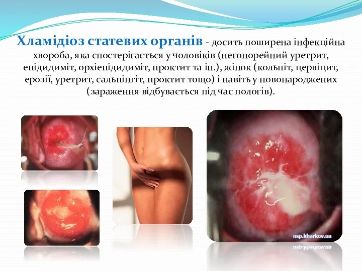 Хламідіоз статевих органів - досить поширена інфекційна хвороба, яка спостерігається
