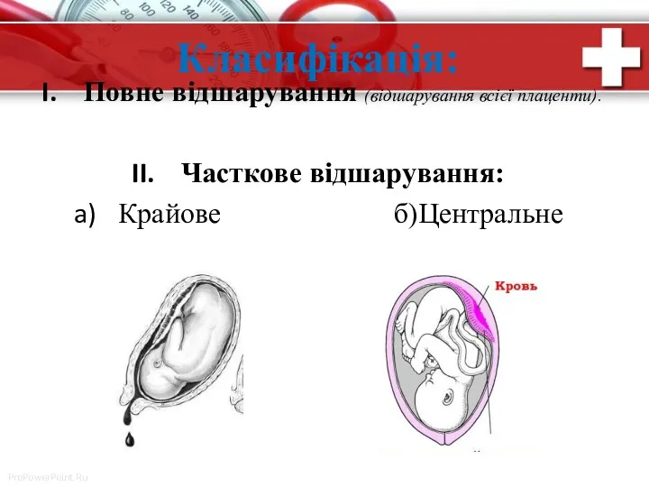 Класифікація: Повне відшарування (відшарування всієї плаценти). Часткове відшарування: Крайове б)Центральне