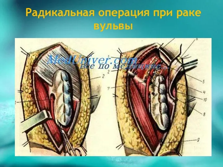 Радикальная операция при раке вульвы