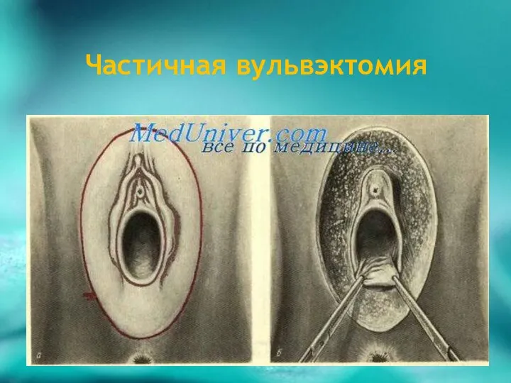 Частичная вульвэктомия