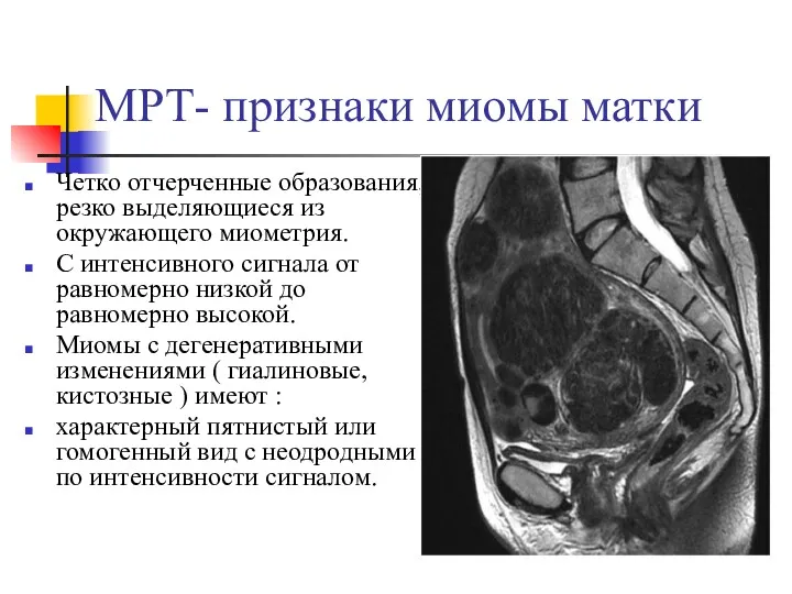 МРТ- признаки миомы матки Четко отчерченные образования, резко выделяющиеся из окружающего миометрия. С