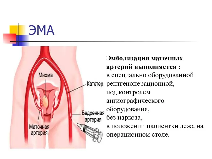 ЭМА Эмболизация маточных артерий выполняется : в специально оборудованной рентгеноперационной, под контролем ангиографического