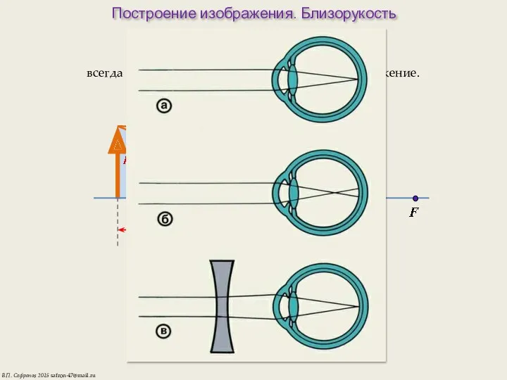Построение изображения. Близорукость РАССЕИВАЮЩАЯ ЛИНЗА всегда дает мнимое прямое уменьшенное изображение. В.П. Сафронов 2015 safron-47@mail.ru