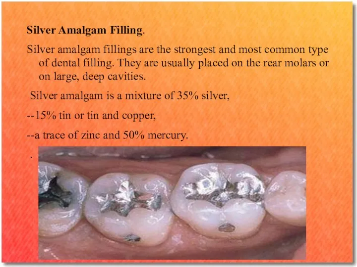 Silver Amalgam Filling. Silver amalgam fillings are the strongest and