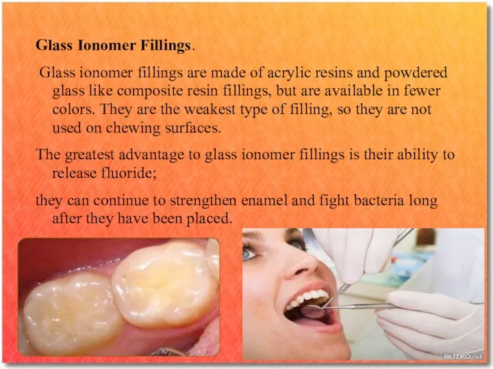 Glass Ionomer Fillings. Glass ionomer fillings are made of acrylic