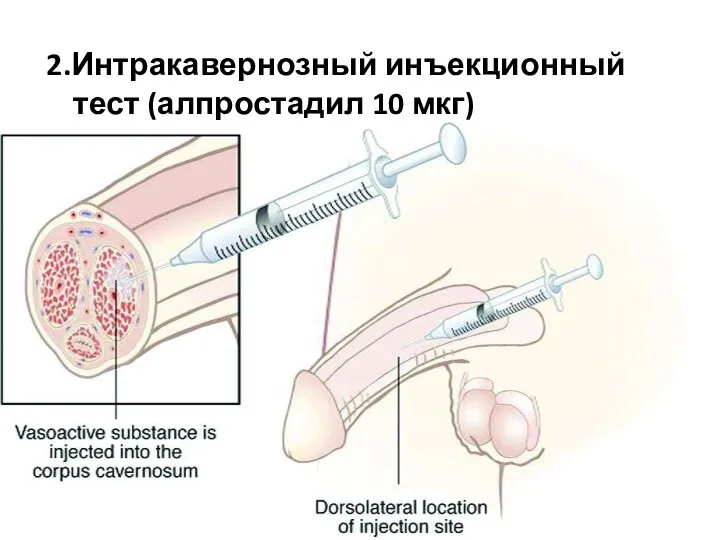 2.Интракавернозный инъекционный тест (алпростадил 10 мкг)