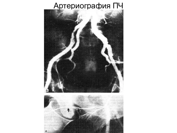 Артериография ПЧ