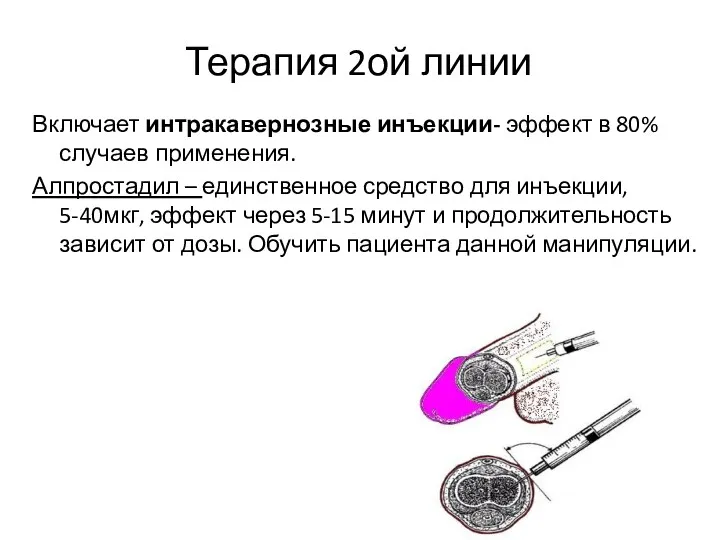 Терапия 2ой линии Включает интракавернозные инъекции- эффект в 80% случаев