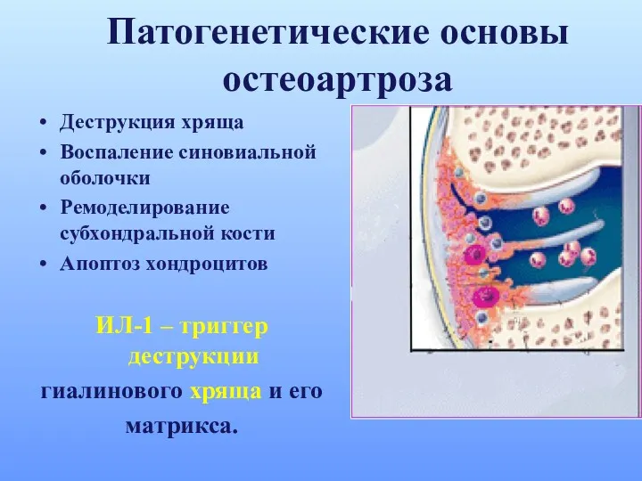 Патогенетические основы остеоартроза Деструкция хряща Воспаление синовиальной оболочки Ремоделирование субхондральной