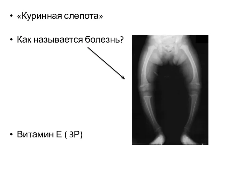 «Куринная слепота» Как называется болезнь? Витамин Е ( 3Р)