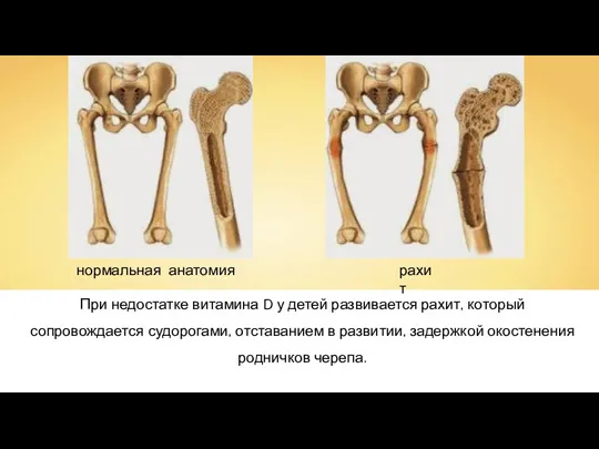 При недостатке витамина D у детей развивается рахит, который сопровождается