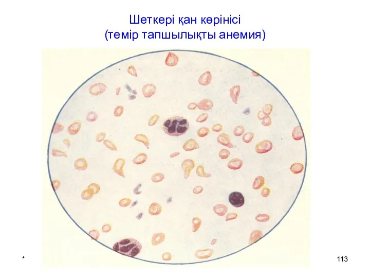 * патофизиология кафедрасы Шеткері қан көрінісі (темір тапшылықты анемия)