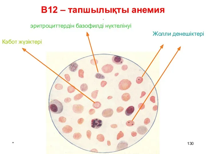 * патофизиология кафедрасы В12 – тапшылықты анемия . эритроциттердін базофилді нүктелінуі Жолли денешіктері Кэбот жүзіктері