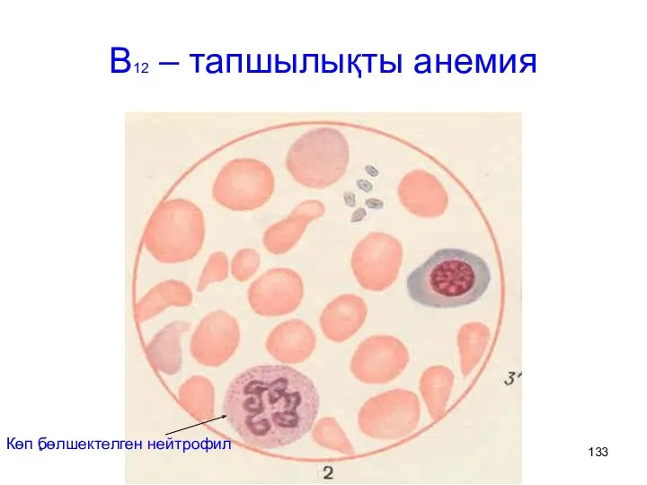 * патофизиология кафедрасы В12 – тапшылықты анемия Көп бөлшектелген нейтрофил