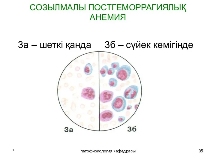 * патофизиология кафедрасы СОЗЫЛМАЛЫ ПОСТГЕМОРРАГИЯЛЫҚ АНЕМИЯ 3а – шеткі қанда 3б – сүйек кемігінде