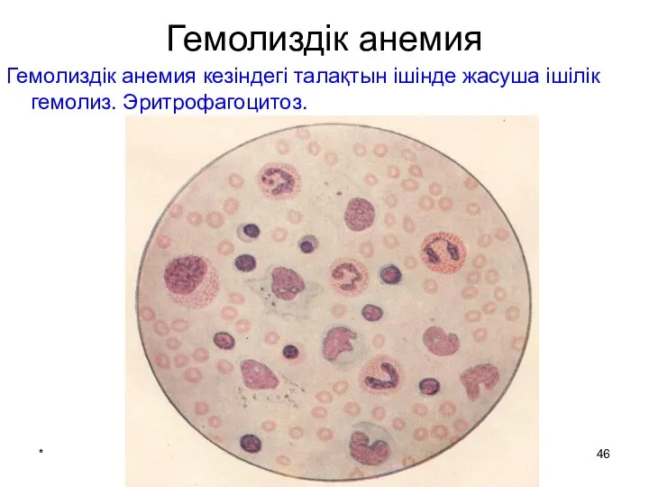 * патофизиология кафедрасы Гемолиздік анемия Гемолиздік анемия кезіндегі талақтын ішінде жасуша ішілік гемолиз. Эритрофагоцитоз.