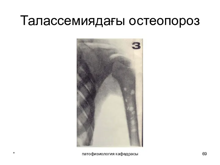 * патофизиология кафедрасы Талассемиядағы остеопороз