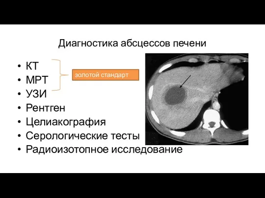 Диагностика абсцессов печени КТ МРТ УЗИ Рентген Целиакография Серологические тесты Радиоизотопное исследование золотой стандарт