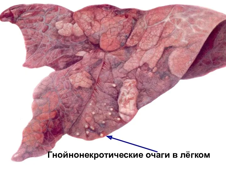 Гнойнонекротические очаги в лёгком