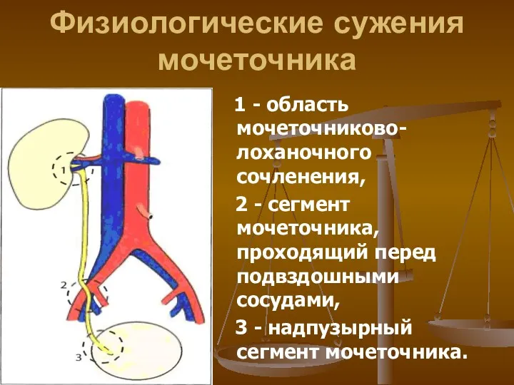 Физиологические сужения мочеточника 1 - область мочеточниково-лоханочного сочленения, 2 -