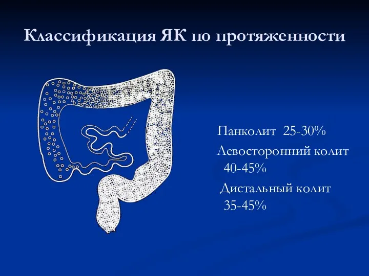 Классификация ЯК по протяженности Панколит 25-30% Левосторонний колит 40-45% Дистальный колит 35-45%