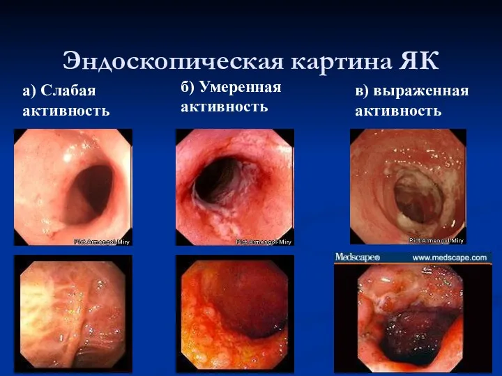 Эндоскопическая картина ЯК а) Слабая активность б) Умеренная активность в) выраженная активность