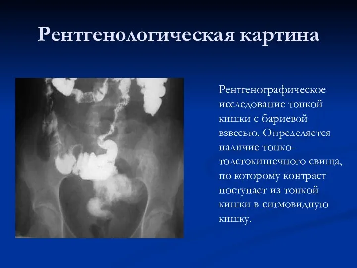 Рентгенографическое исследование тонкой кишки с бариевой взвесью. Определяется наличие тонко-толстокишечного