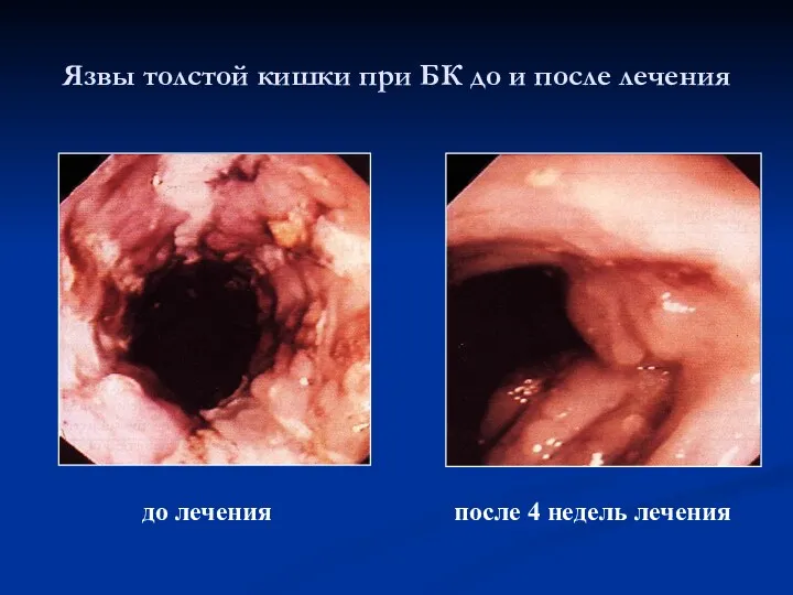 до лечения после 4 недель лечения Язвы толстой кишки при БК до и после лечения