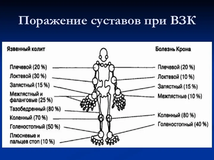 Поражение суставов при ВЗК