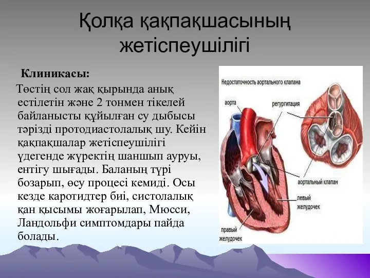 Қолқа қақпақшасының жетіспеушілігі Клиникасы: Төстің сол жақ қырында анық естілетін