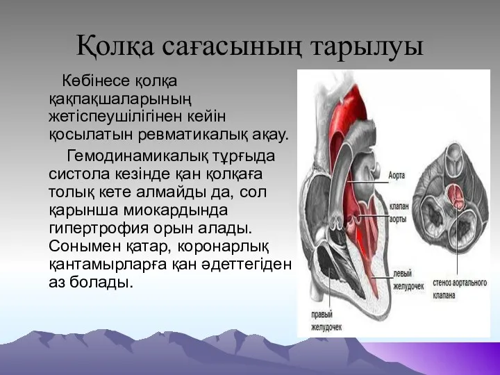 Қолқа сағасының тарылуы Көбінесе қолқа қақпақшаларының жетіспеушілігінен кейін қосылатын ревматикалық