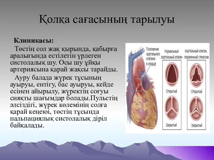 Қолқа сағасының тарылуы Клиникасы: Төстің сол жақ қырында, қабырға аралығында