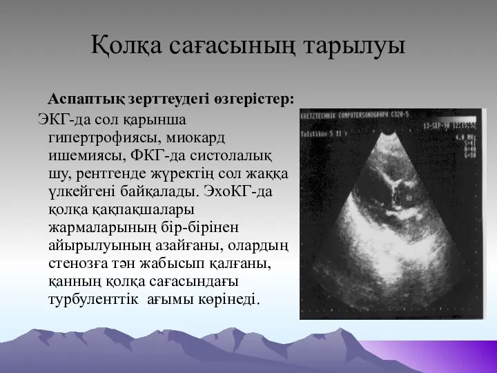 Қолқа сағасының тарылуы Аспаптық зерттеудегі өзгерістер: ЭКГ-да сол қарынша гипертрофиясы,