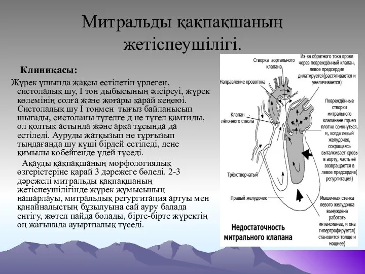 Митральды қақпақшаның жетіспеушілігі. Клиникасы: Жүрек ұшында жақсы естілетін үрлеген, систолалық