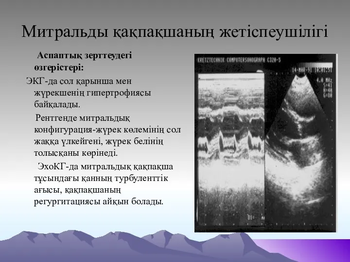 Митральды қақпақшаның жетіспеушілігі Аспаптық зерттеудегі өзгерістері: ЭКГ-да сол қарынша мен