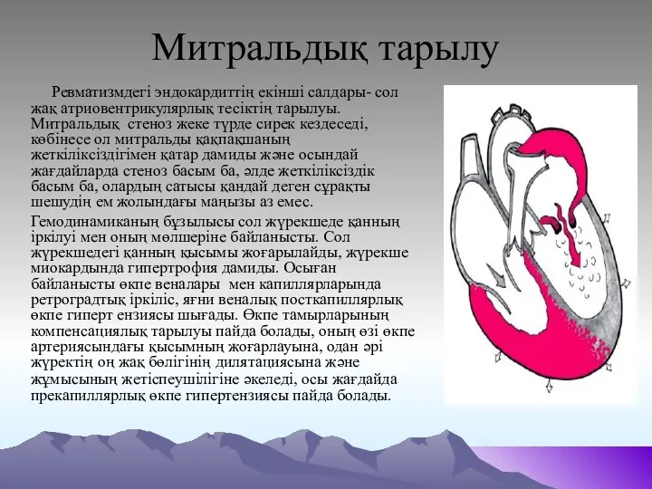 Митральдық тарылу Ревматизмдегі эндокардиттің екінші салдары- сол жақ атриовентрикулярлық тесіктің