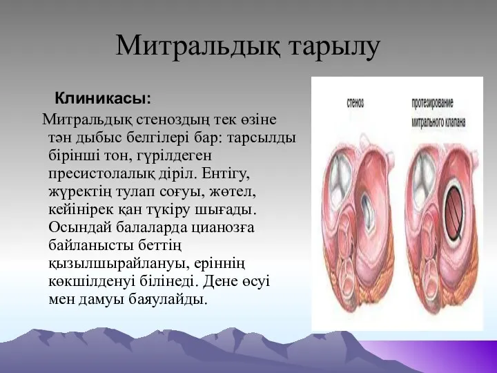 Митральдық тарылу Клиникасы: Митральдық стеноздың тек өзіне тән дыбыс белгілері