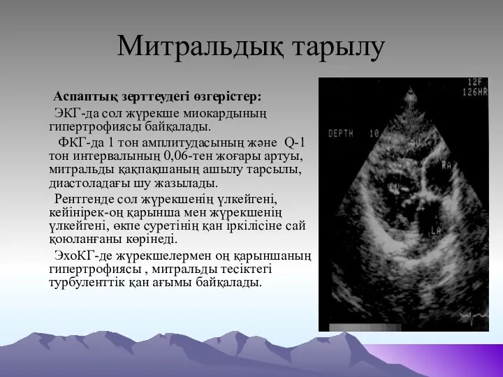 Митральдық тарылу Аспаптық зерттеудегі өзгерістер: ЭКГ-да сол жүрекше миокардының гипертрофиясы