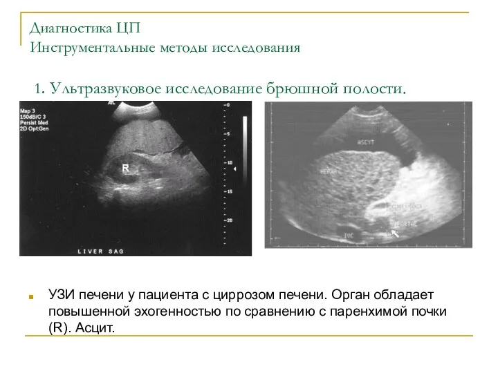 Диагностика ЦП Инструментальные методы исследования 1. Ультразвуковое исследование брюшной полости.