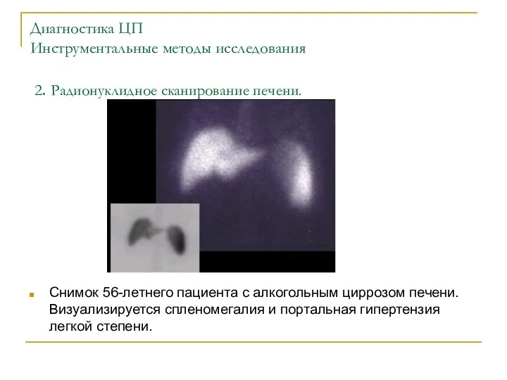 Диагностика ЦП Инструментальные методы исследования 2. Радионуклидное сканирование печени. Снимок