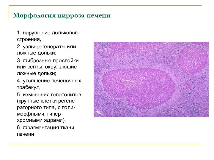 Морфология цирроза печени 1. нарушение долькового строения, 2. узлы-регенераты или