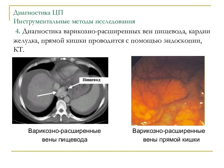 Диагностика ЦП Инструментальные методы исследования 4. Диагностика варикозно-расширенных вен пищевода,