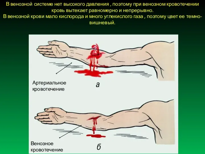 В венозной системе нет высокого давления , поэтому при венозном кровотечении кровь вытекает