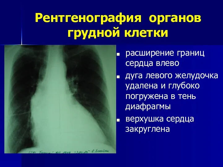 Рентгенография органов грудной клетки расширение границ сердца влево дуга левого