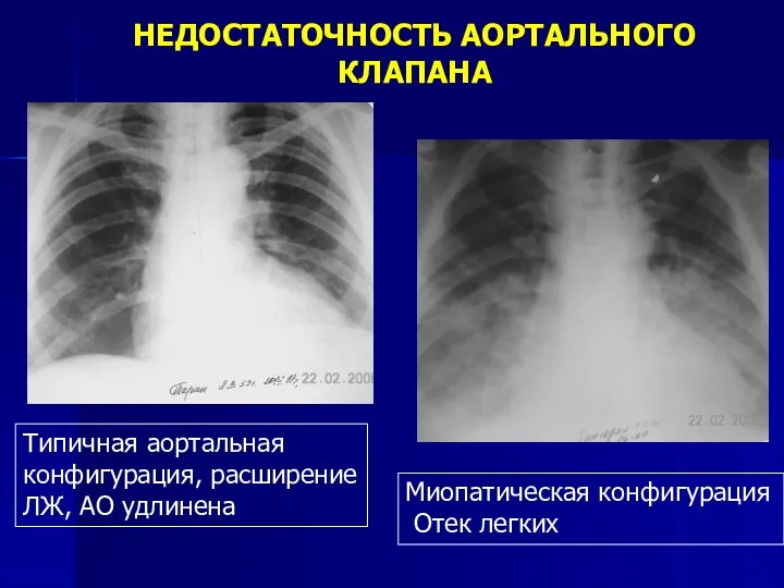 НЕДОСТАТОЧНОСТЬ АОРТАЛЬНОГО КЛАПАНА Типичная аортальная конфигурация, расширение ЛЖ, АО удлинена Миопатическая конфигурация Отек легких