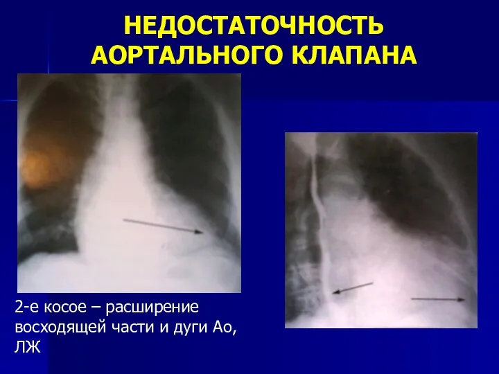 НЕДОСТАТОЧНОСТЬ АОРТАЛЬНОГО КЛАПАНА 2-е косое – расширение восходящей части и дуги Ао, ЛЖ