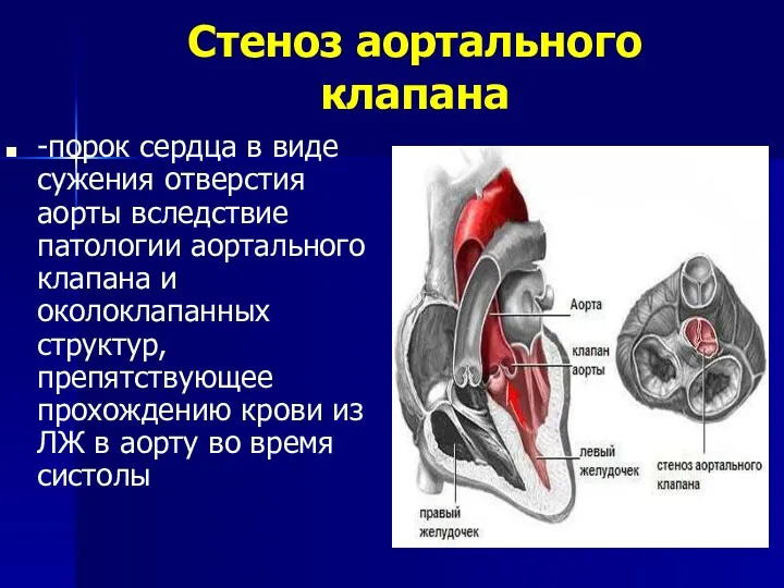 Стеноз аортального клапана -порок сердца в виде сужения отверстия аорты